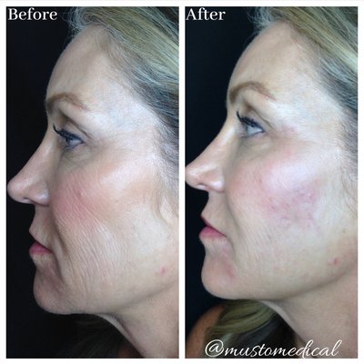 Liquid Face Lift