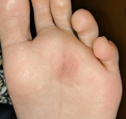 Wart gone, no reoccurrence!