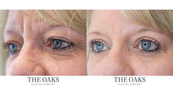 Upper Blepharoplasty by Dr. Andry