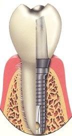 Dental Implant Placement and Restoration