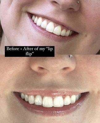 Botox - lip flip