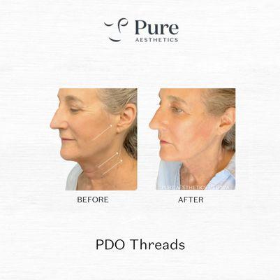 PDO Threadlift at Pure Aesthetics