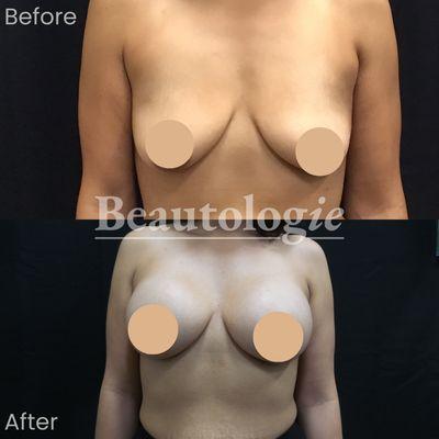 Bilateral Breast Augmentation with 500ml Saline Implants Before and After