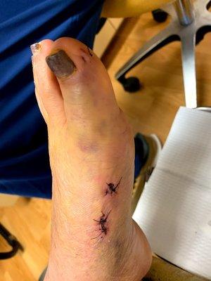 bunion surgery 1 week after surgery: minimally invasive technique with tiny incisions leads to minimal scarring, less pain, faster recovery