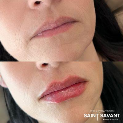 RESTORED VOLUME & DEFINITION to LIPS using Dermal Filler