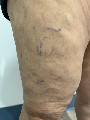 Varicose veins can be treated with very simple minimally invasive same-day approaches that require 0 downtime