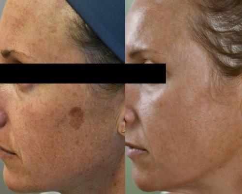 Age spot removal with q-switched lasers and IPL, Photofacial, fotofacial.