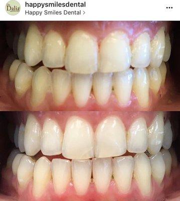 Before and after our basic teeth whitening service; $60 per 30 min session. Research shows that your smile is your most noticed feature.