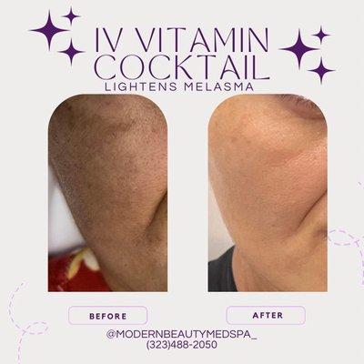 Before and after results 
IV vitamin cocktail lightens melasma