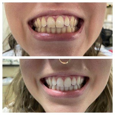 Great results with KOR whitening!