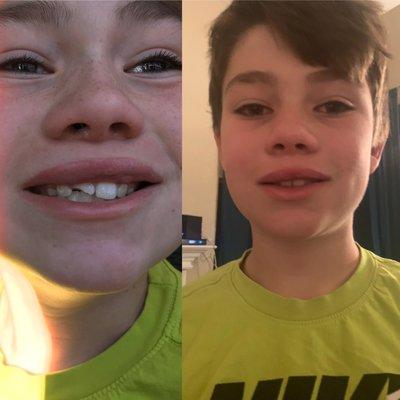 They did such an amazing job fixing his tooth.