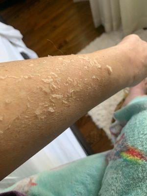 Chemical peel on arms. The baby skin came out and hyperpigmentation was almost gone.