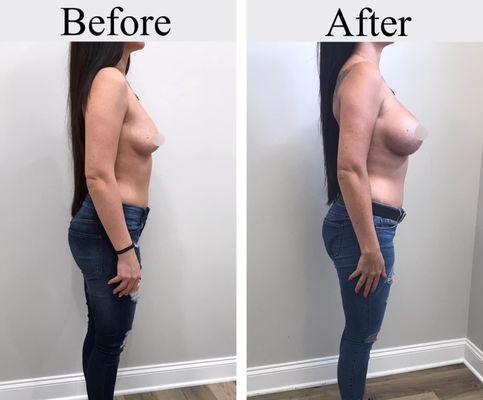 Before and After
Procedure: Breast Augmentation