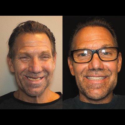 Smile Makeover