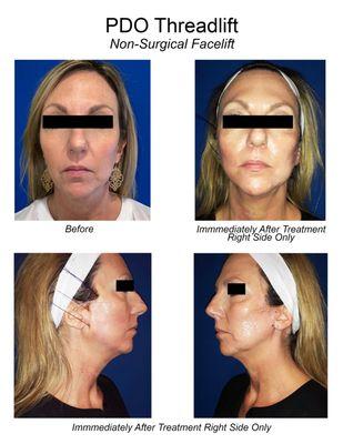 Actual Patient - PDO Facelift Half Way in Process