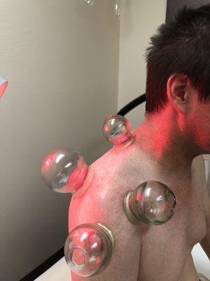 Cupping of shoulder