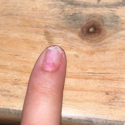 I was soaking my acrylics of and my finger nail underneath is now infected as you can see the green circle to the right