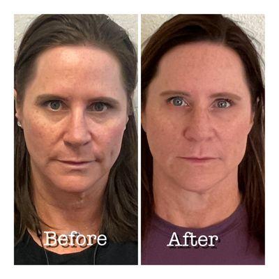 Juvederm Treatment