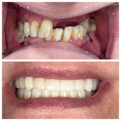 This patient received full arch fixed zirconia prostheses on top and bottom on 12 total implants