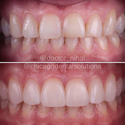 Six Upper Porcelain Veneers