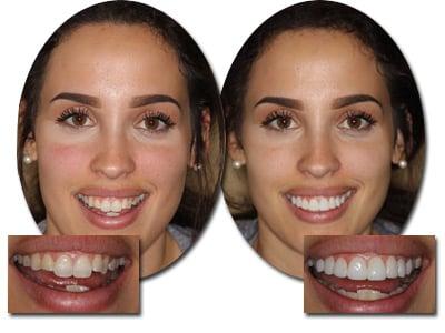 1 visit Smile Makeover with EasySmile Veneers, no removal of healthy tooth structure!