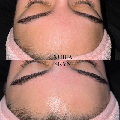 Before & After Express Dermaplaning Facial