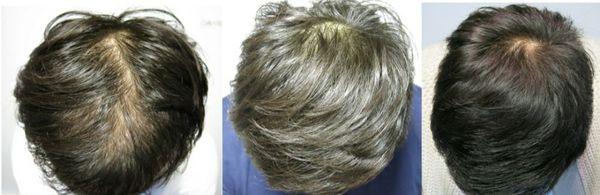 DAMO non-surgical scalp treatment case 
30's Male pattern