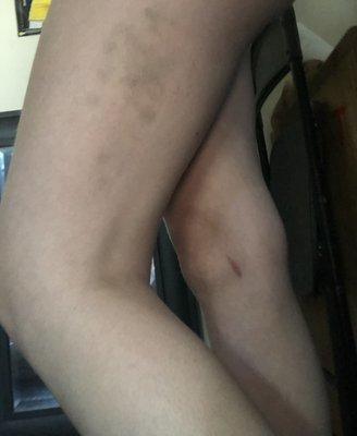 Bruises from the massage.