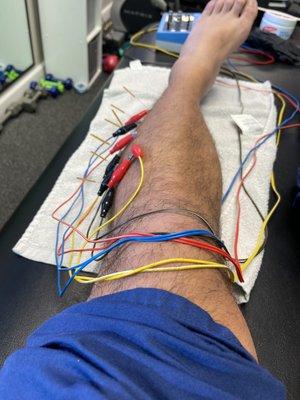 Dry needling to release the muscle tension