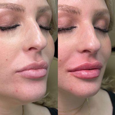 The most gorgeous full figured lips with just a touch of filler