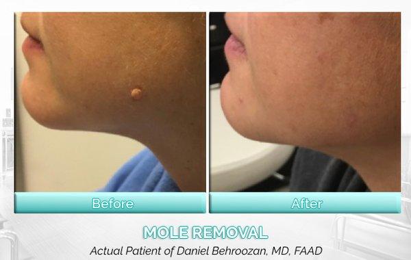 Mole removal requires experience and precision to not only remove the mole in its entirety, but also to ensure that scarring is minimal.