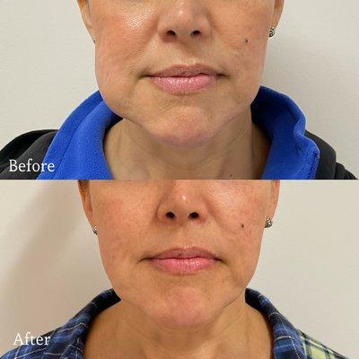 Kybella for lipomas and jowls