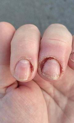 Infection from nail services