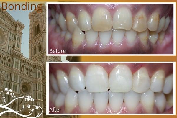 Dental bonding is a procedure in which a tooth-colored resin material is applied and hardened with a special light