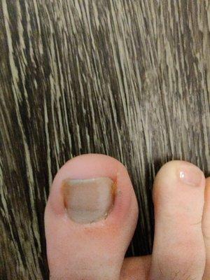 Infected nail after pedicure job - they said I came in with an infected nail even though the podiatrist said it was from pedi