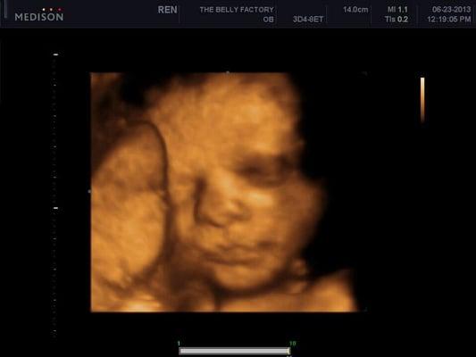 Second ultrasound...