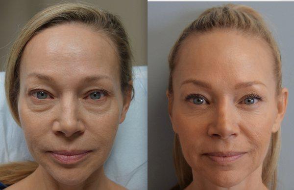 Before and After Lower Eyelid Surgery