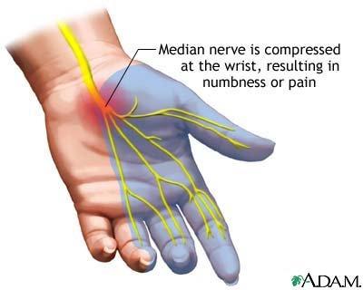 carpal tunnel syndrome