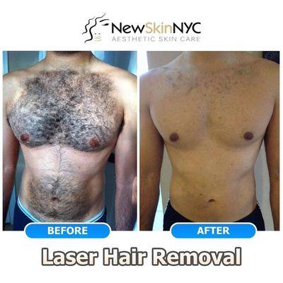 Laser Hair Removal