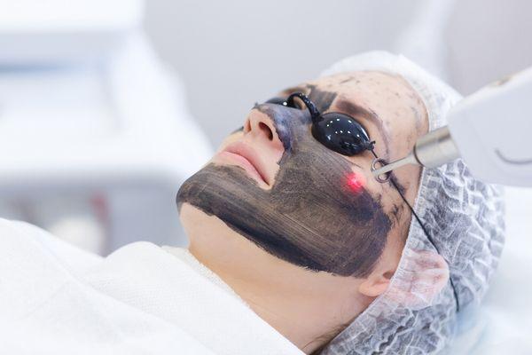 Carbon facial laser peel .