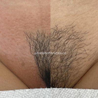 brazilian wax before & after- leaving a triangular shape of hair left