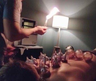 Fire cupping treatment