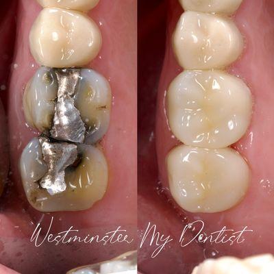 Replacement of failing Amalgam fillings with Ceramic crowns.