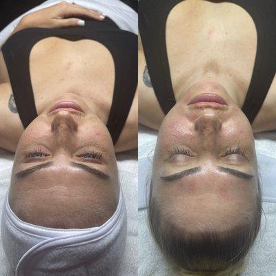 Microdermabrasion before and after.