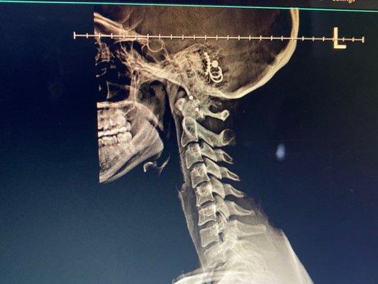 cervical spine lateral view