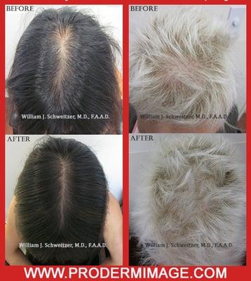 Results after one single Platelet Rich Plasma (PRP) Injection Therapy