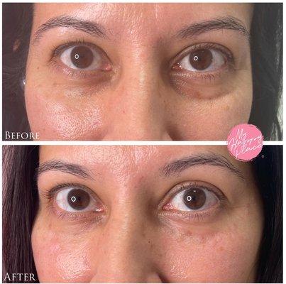 Before & immediately after tear trough filler. I use ultrasound guidance to avoid the facial artery.