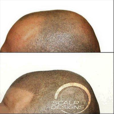 Before & After of Scalp Designs client