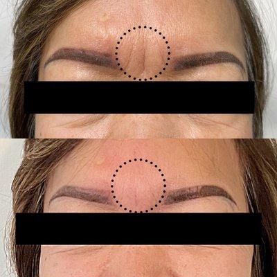 Client received botox to reduce appearance of fine wrinkles. For her frown lines caused by collagen breakdown, she received Dermal filler!