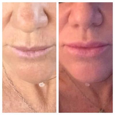 Lips done left pic was taken 1 week ago! They are great thank you Lisa!